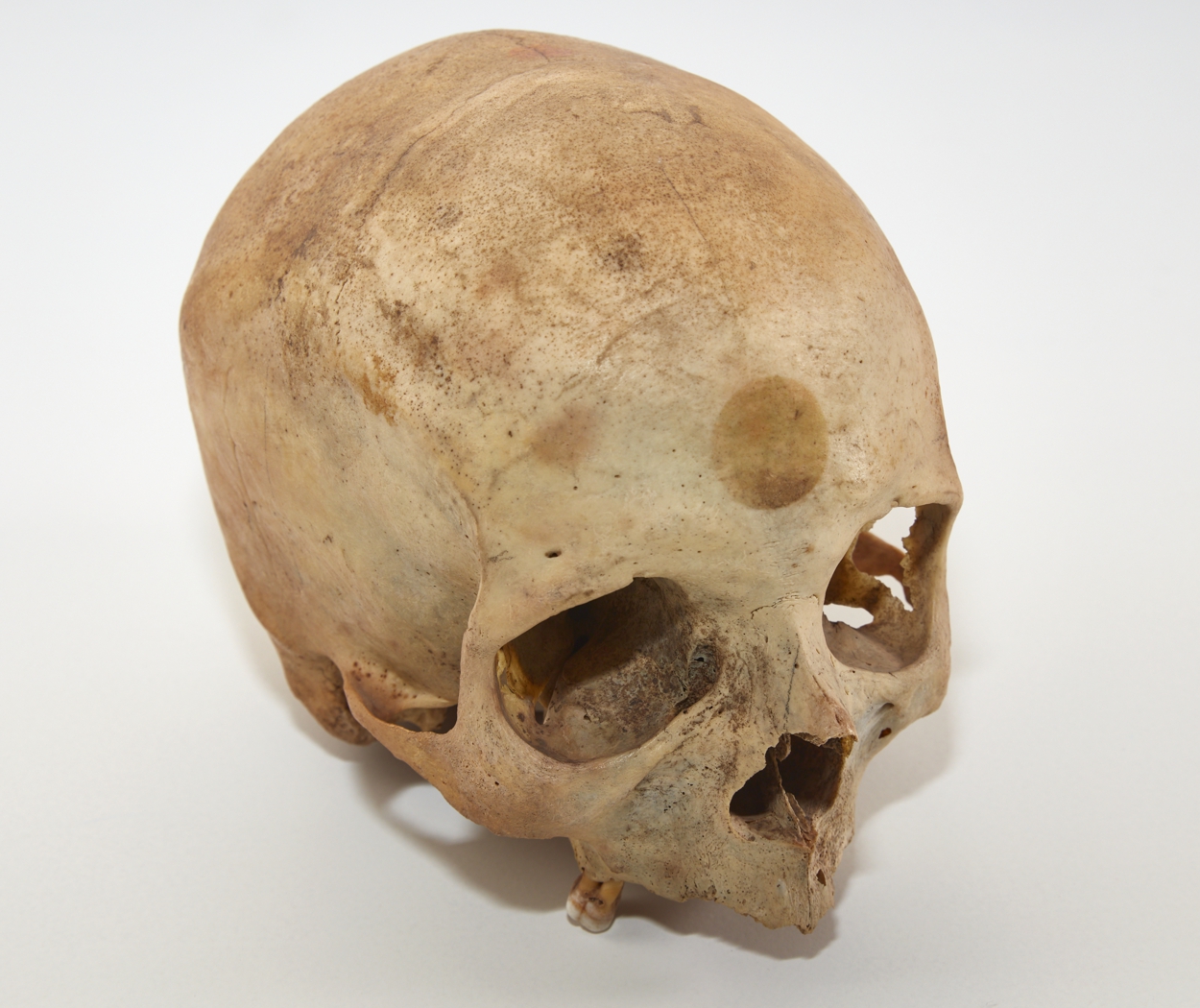 El Museo Canario, mänsklig skalle